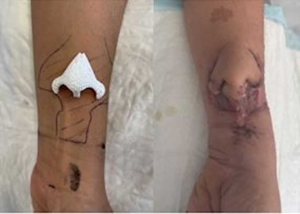 Zwei Monate lang wuchs die neue Nase auf dem Arm der Frau, bevor sie in ihr Gesicht transplantiert wurde.