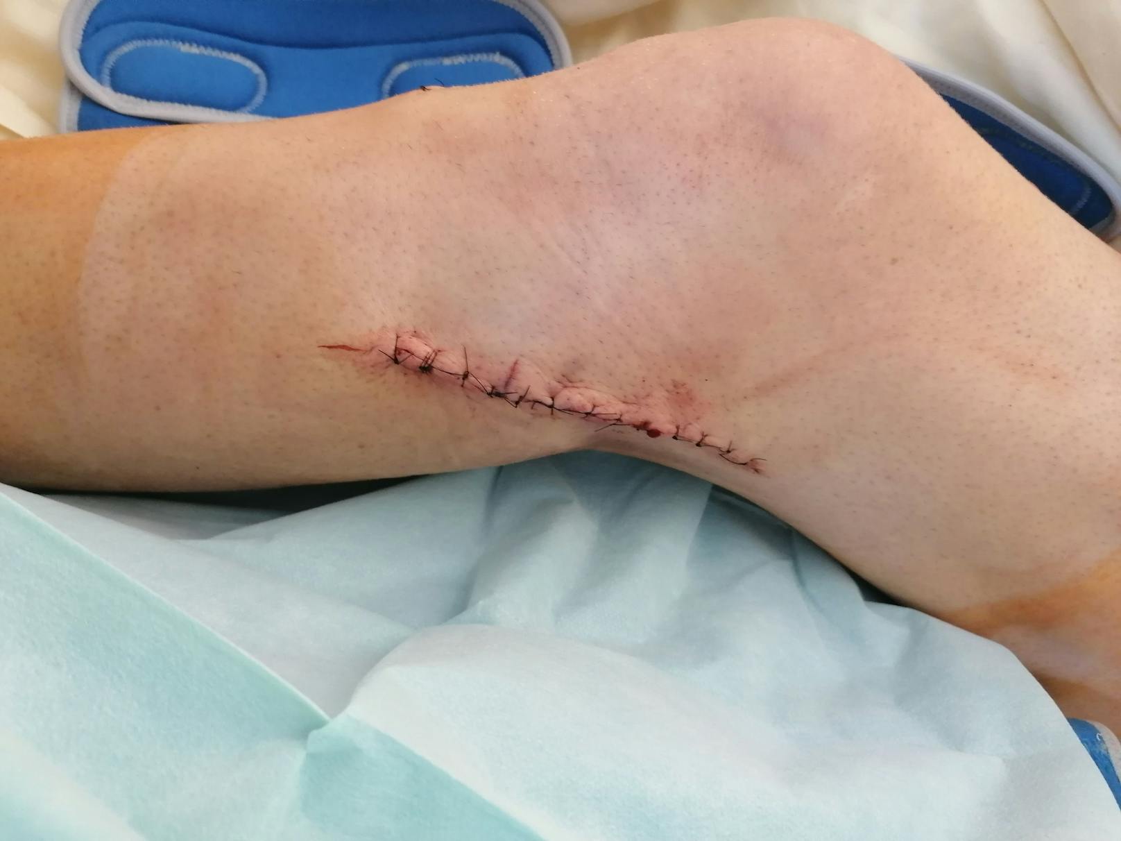 U.a. Seitenband kaputt, ein Muskel riss ein - Thomas S. wurde am Montag operiert.