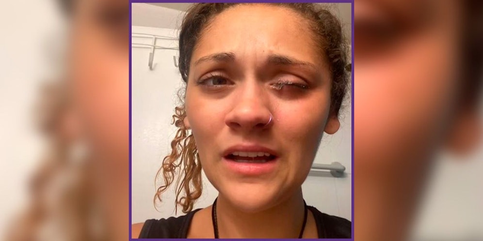 Lyd mit ihrem verklebten Auge.