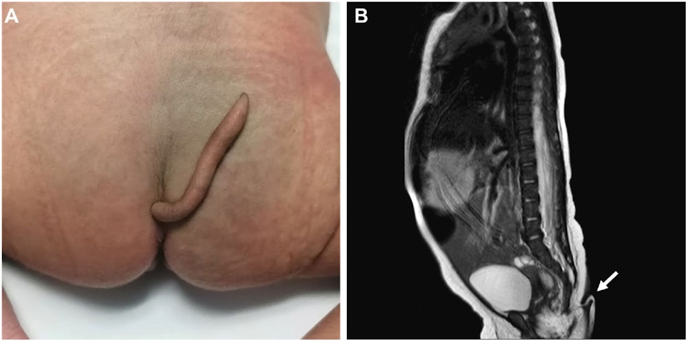 Das Anhängsel bestand aus Gewebe und Fett und konnte von den Chirurgen erfolgreich entfernt werden. 