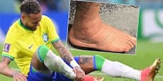 Schwellung! Neymar zeigt Verletzung auf Instagram