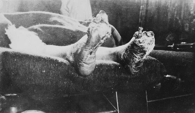 Unbekannter französischer Soldat mit "Grabenfuß" im Ersten Weltkrieg, 1917.