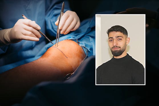 Beritan C. (18) wurde das Wadenbein in den Oberschenkel "eingepflanzt".