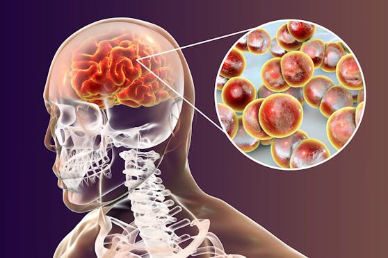 Sowohl bei Meningokokken als auch bei Pneumokokken kann es zu einer lebensgefährlichen Hirnhautentzündung kommen.