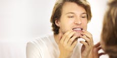 Ärzte warnen – Zähne bleichen kann zu Verätzung führen