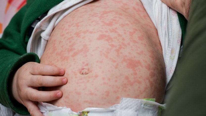 Children viral disease or allergies. Red measles rash on baby. Child with viral children disease infection. Concept of viral baby disease and vaccination.