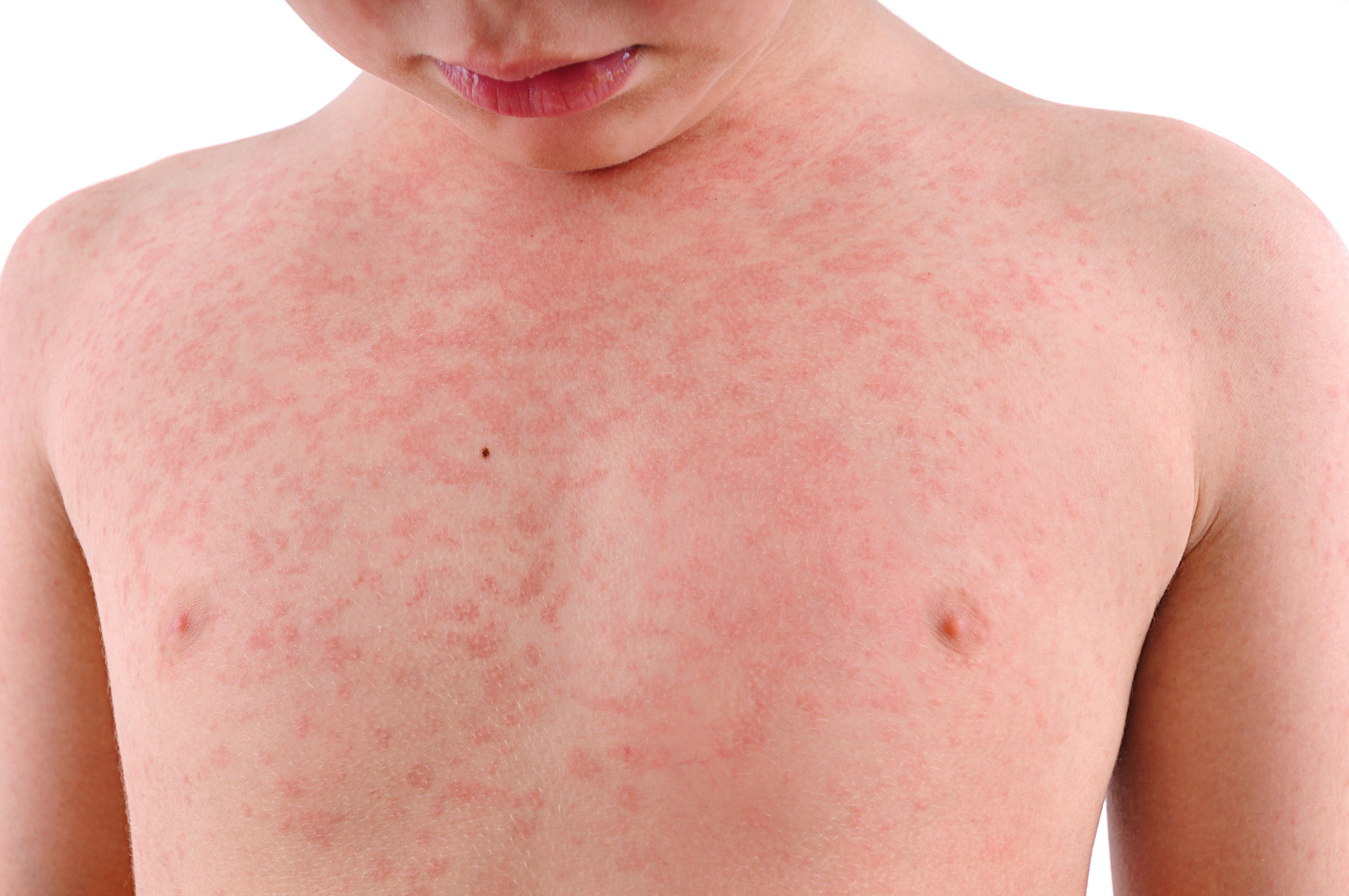 Child's Body Suffering Urticaria      