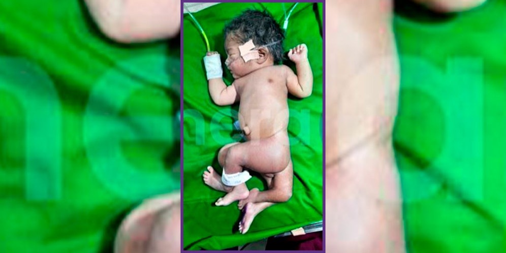 Bis auf ihre zwei zusätzlichen Beine ist das Mädchen wohlauf.