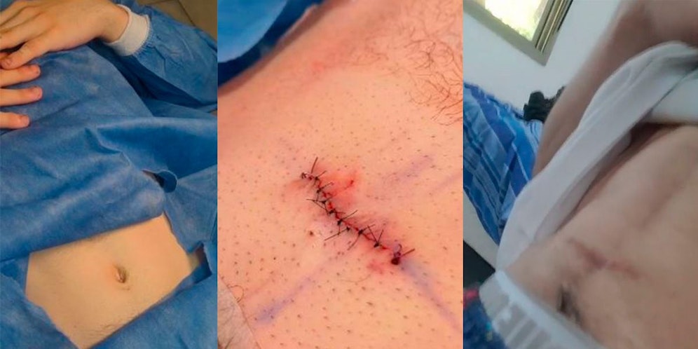 Auf TikTok hat der Argentinier seine Bauchnabelentfernung dokumentiert.