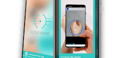 App erkennt zu 98 Prozent Hautkrebs