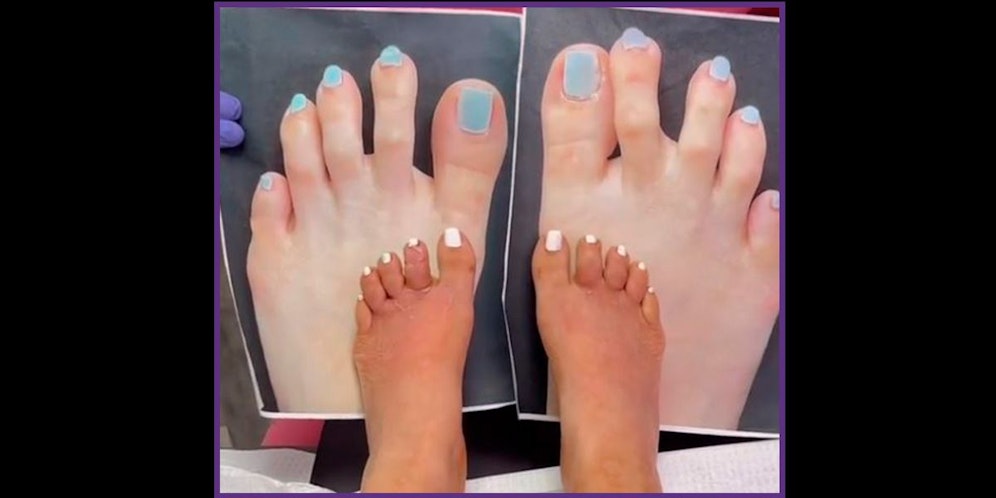 Augrund ihrer langen und krummen Zehen hatte Athena mit ihrem Selbstbewusstsein zu kämpfen.