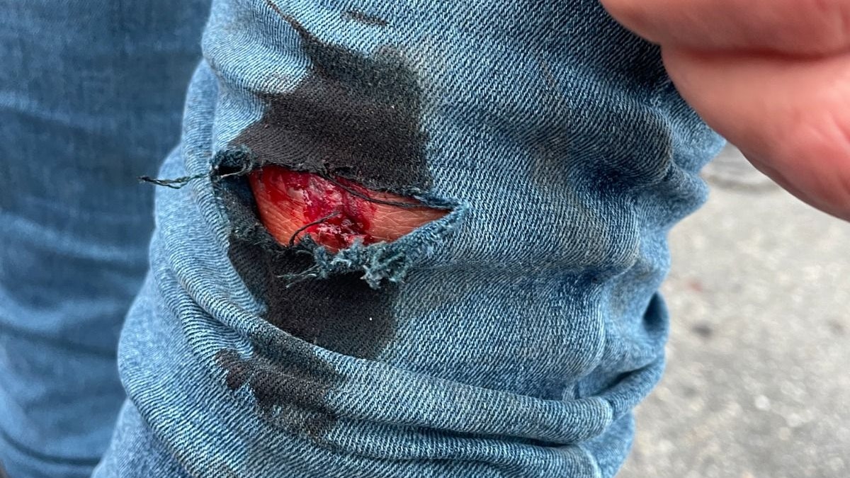 Wienerin wurde am Knie verletzt. 