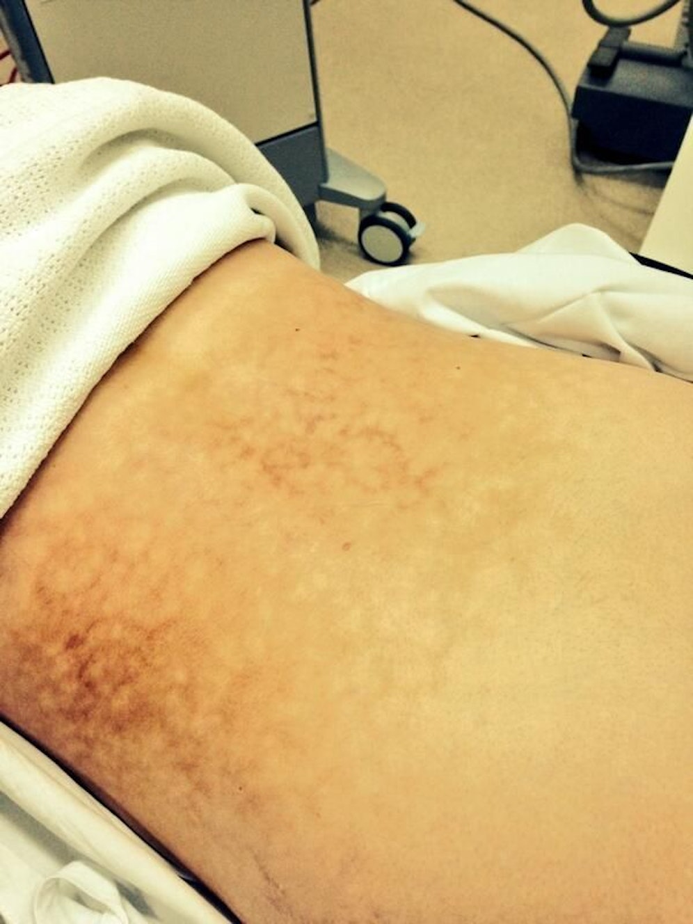 Es droht das Toasted-Skin-Syndrom. Dabei handelt es sich um eine rotbraune, netzartige Hautveränderung. 