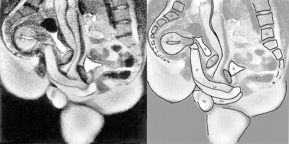 Links das Originalbild, rechts eine vereinfachte Darstellung des Geschlechtsverkehrs: P=Penis, Ur=Harnröhre, Pe=Damm, U=Uterus, S=Symphyse, B=Blase, I=Darm, L5=Lumbal 5, Sc=Hodensack