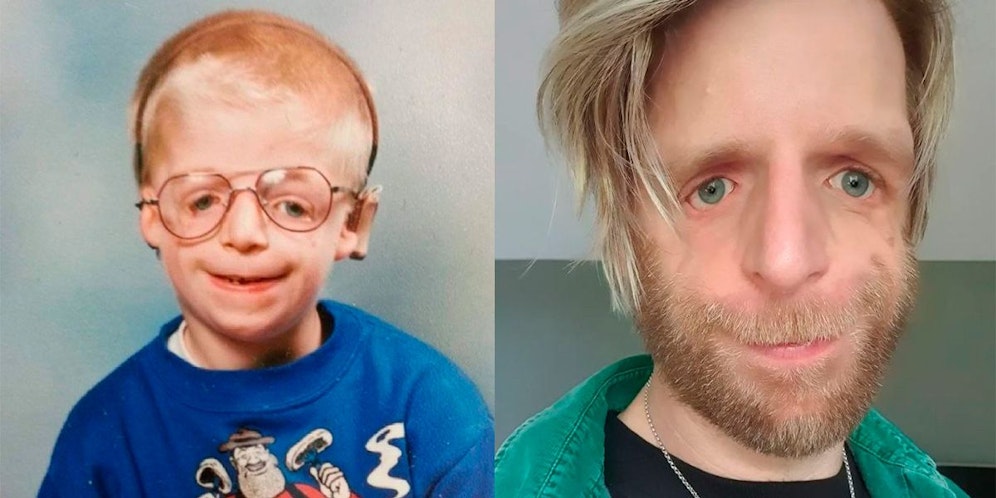 Jonathan Lancaster kam mit dem Treacher-Collins-Syndrom zur Welt.