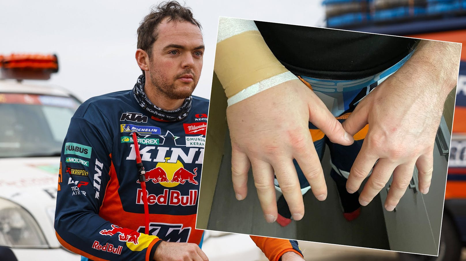 Matthias Walkner zeigt seine verletzte Hand.
