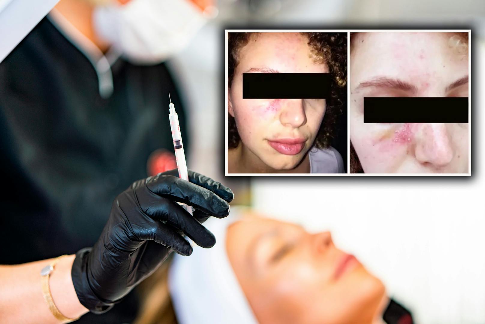 In Wien werden immer mehr illegale Schönheitseingriffe angeboten. Dies führt bei Patientinnen oftmals zu Abszessen, Fibrosen oder Vernarbungen.