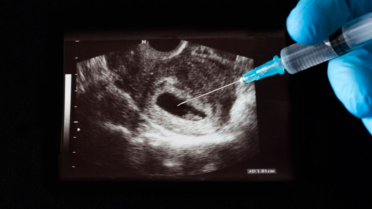 Die Landesregierung in Tirol will Abtreibungen im Krankenhaus.