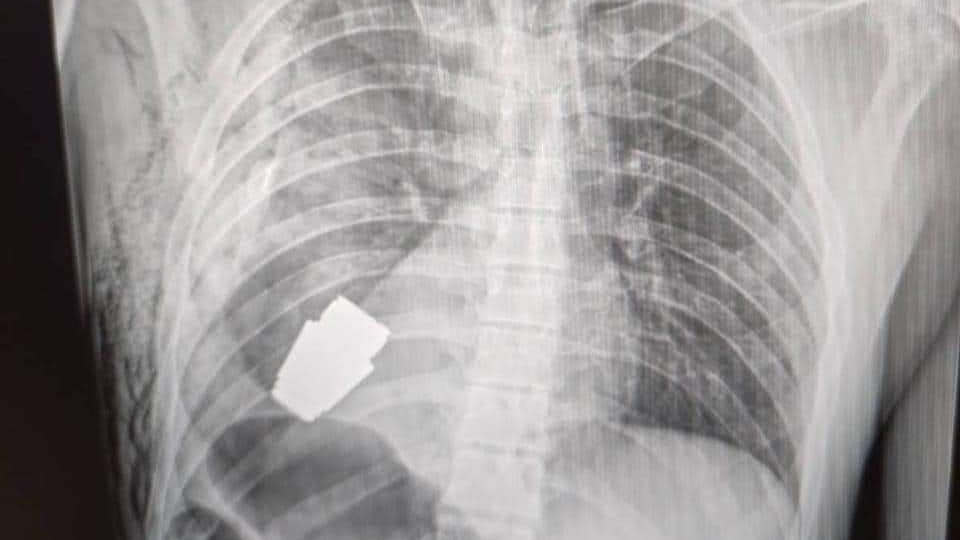 Das sogenannte VOG-Geschoss steckte im Brustkorb des Mannes.