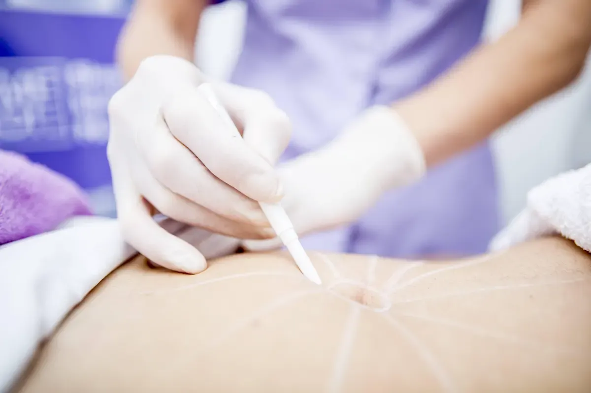 Gemäß Landgericht nahm der Arzt bei den beiden Frauen sogenannte Eigenfetttransfers vor. Dabei wird Körperfett an einer Stelle abgesaugt und in ein anderes Körperteil gespritzt.