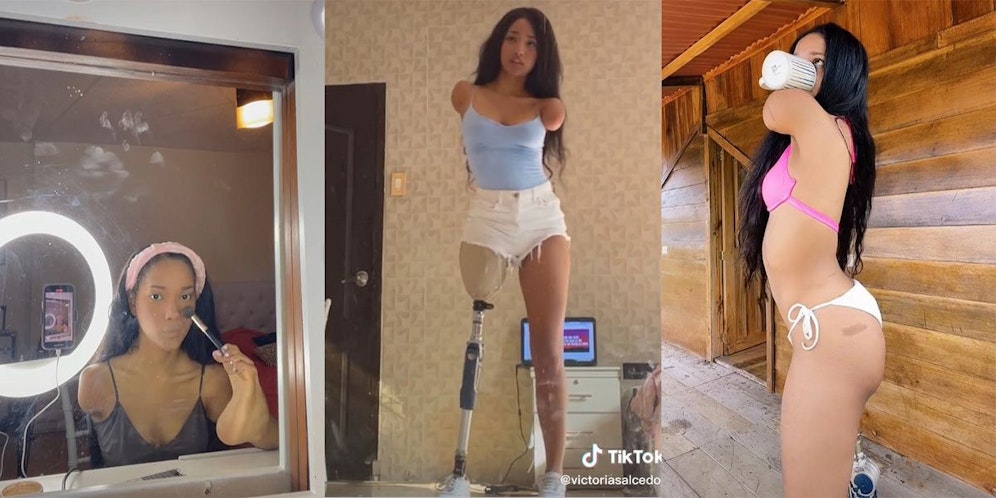 Victoria Salcedo mussten im Alter von 6 Jahren ihre Gliedmaßen amputiert werden, nachdem sie Verbrennungen dritten Grades erlitten hatte.