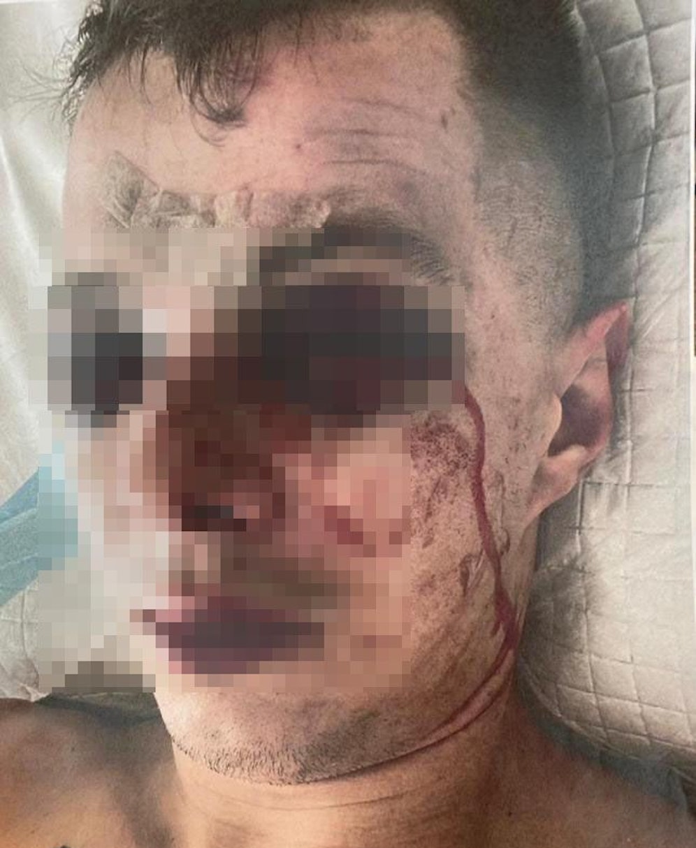 Das Opfer der brutalen Schlägerei nach dem Vorfall schwer verletzt im Spital
