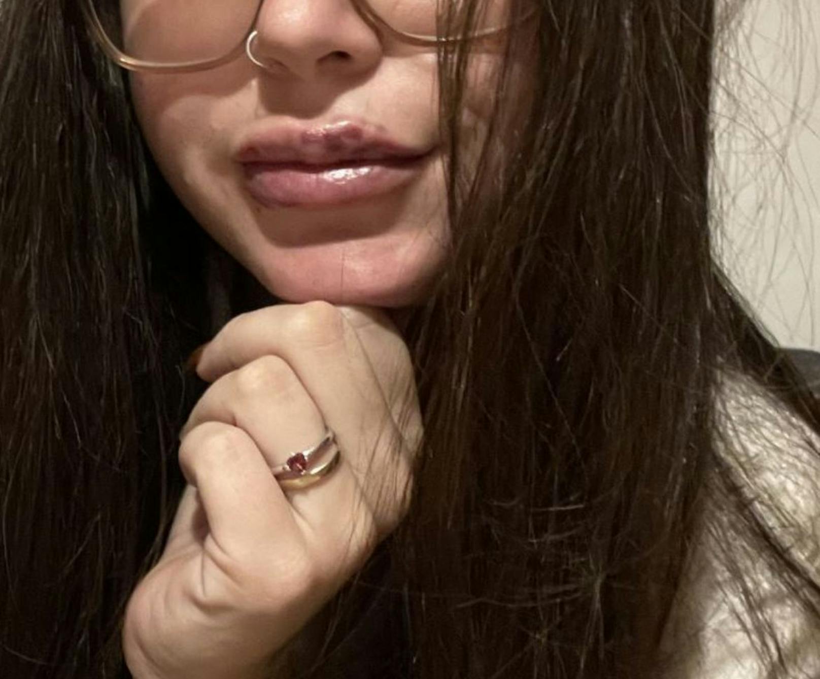 Die 24-jährige Wienerin, die sich selbst "Duffy Duck" nennt, hatte nach der ersten Behandlung in der falschen Beauty-Klinik in Wien Hämatome um die Lippen.