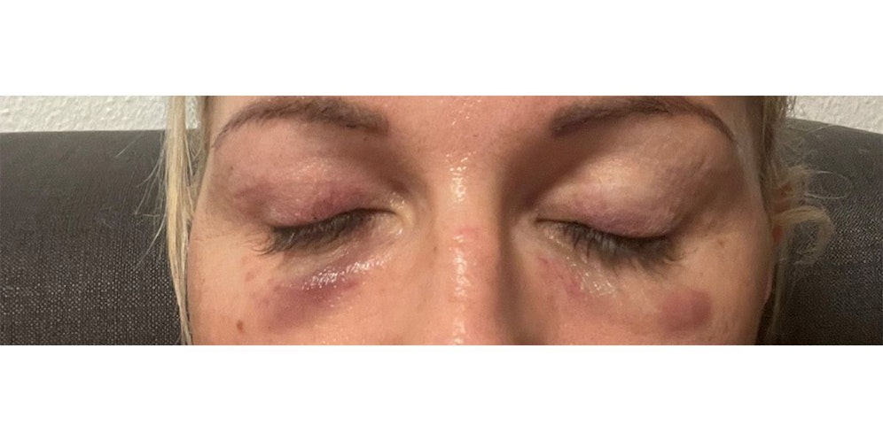 So sah Carina nach der Behandlung aus.