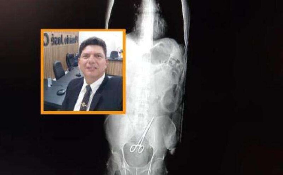 Cleyton Jose Zanatta, Stadtrat der Gemeinde Nova Santa Helena im Bundesstaat Mato Grosso (kl. Bild) mit der Schere, die in seinem Bauch vergessen wurde.