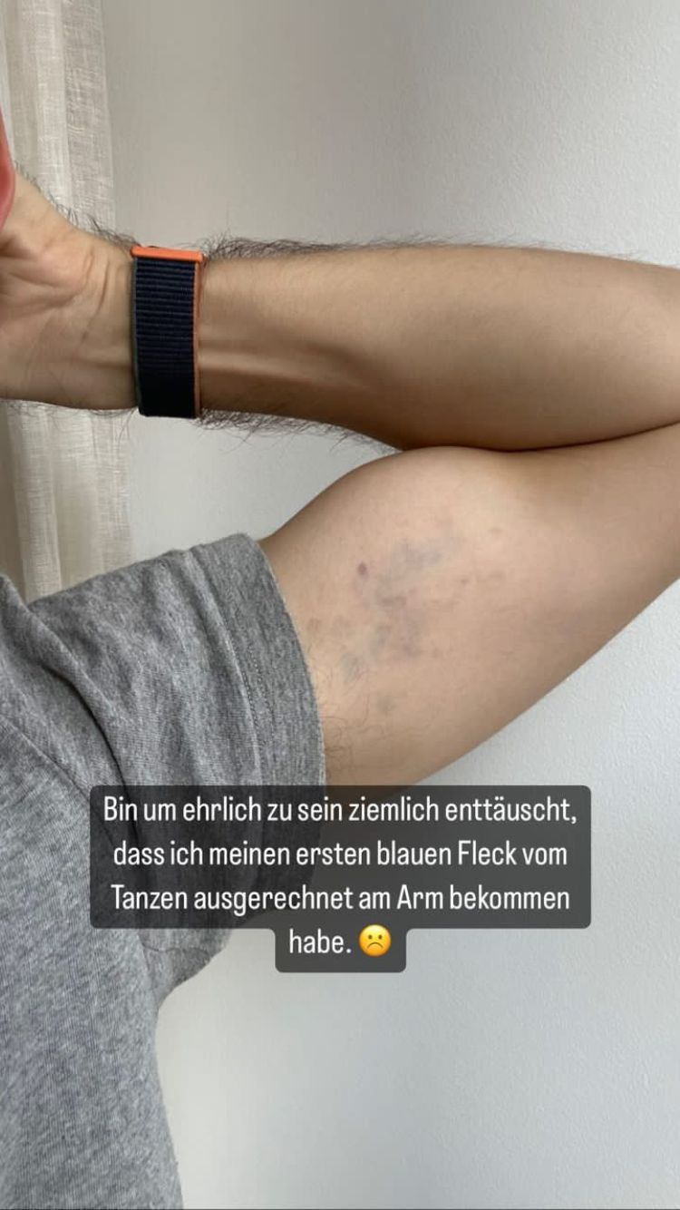 "Dancing Star" Michi Buchinger hat bereits blaue Flecken.