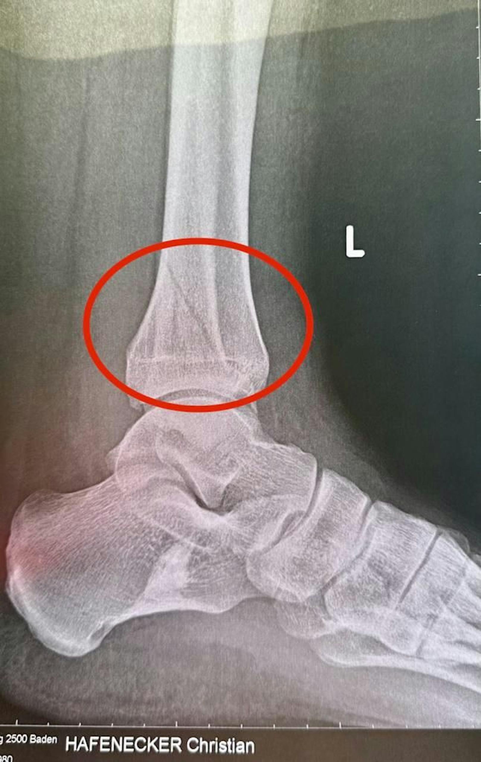 FPÖ-Generalsekretär Hafenecker hat sich Bein gebrochen - das Röntgenbild