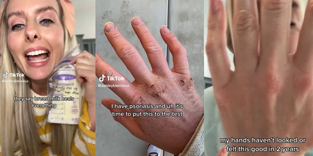 Ashley Lemieux (Bild) schwört auf Muttermilch zur Behandlung ihrer Schuppenflechte.&nbsp;