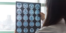 19-Jähriger ist jüngster Patient mit Alzheimer-Diagnose