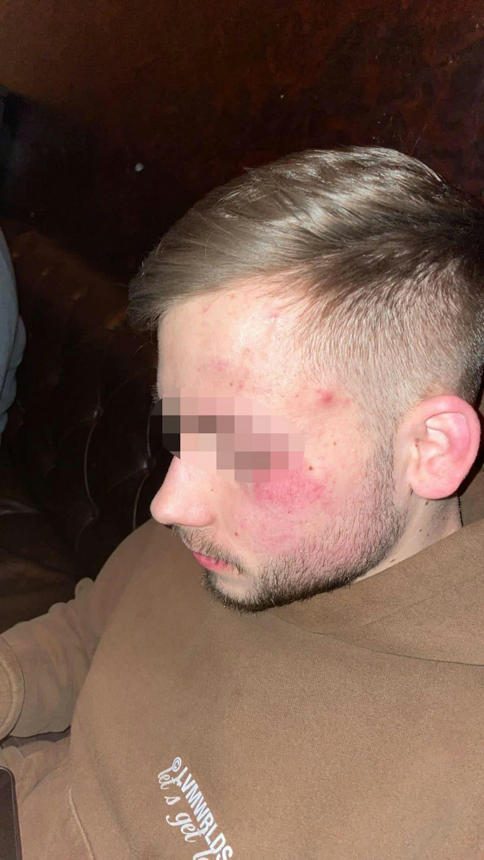 Opfer Lukas (19) erlitt Verletzungen im Gesicht