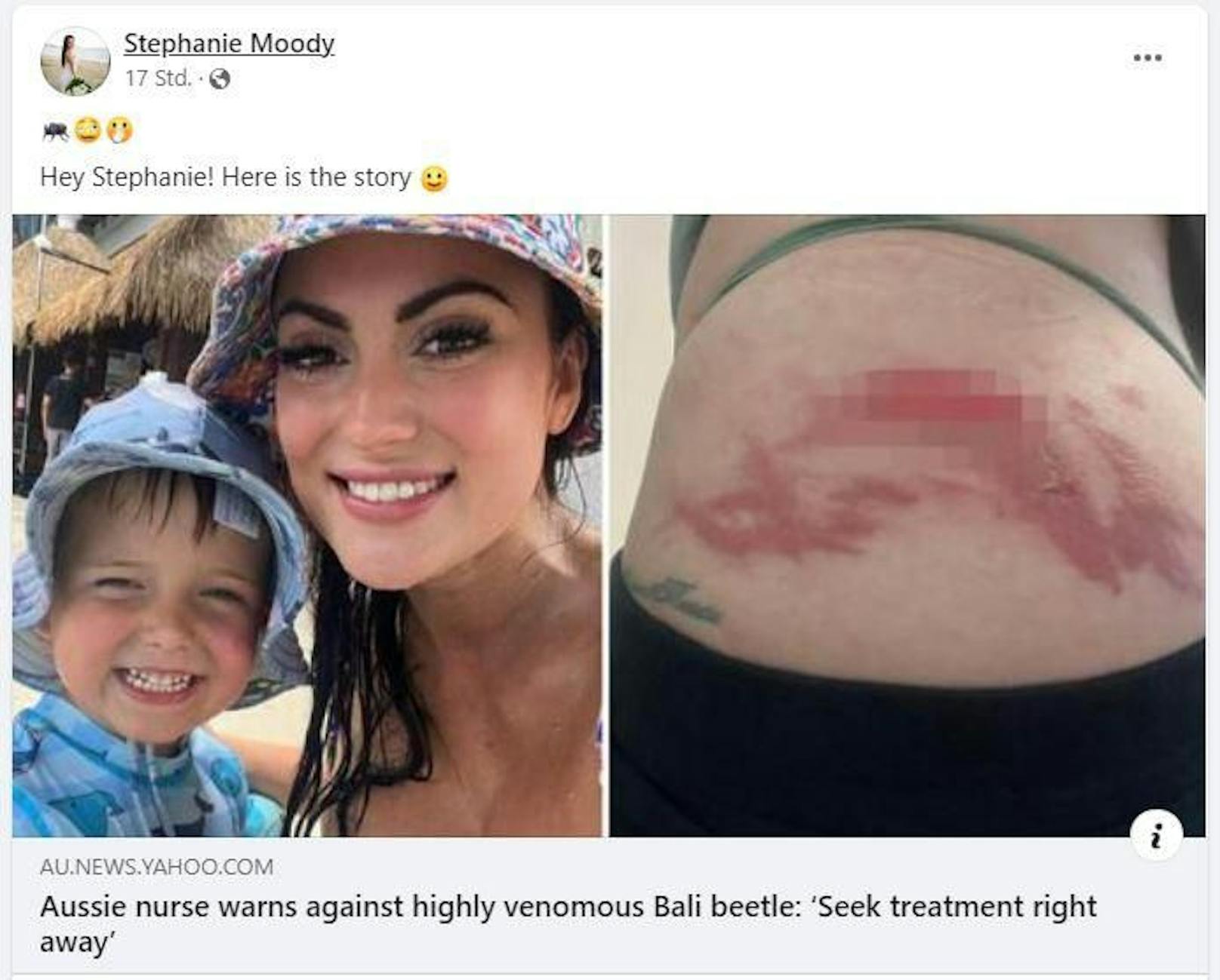 Stephanie Moody aus Australien machte mit ihrer Familie Ferien auf Bali, als sie plötzlich einen Hautausschlag auf ihrer Schulter bemerkte.