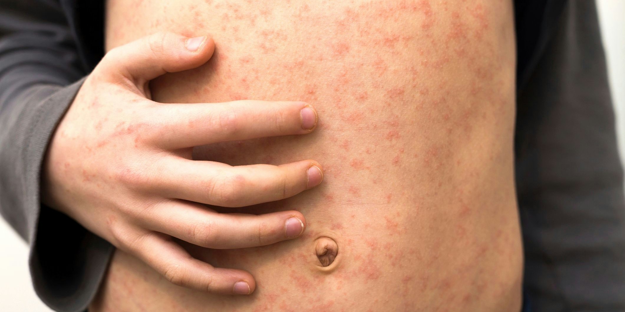 Mehrere Kinder haben sich in der Steiermark mit Masern angesteckt.