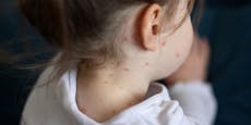 Weniger Masern-Impfungen – sechs Kinder im Spital