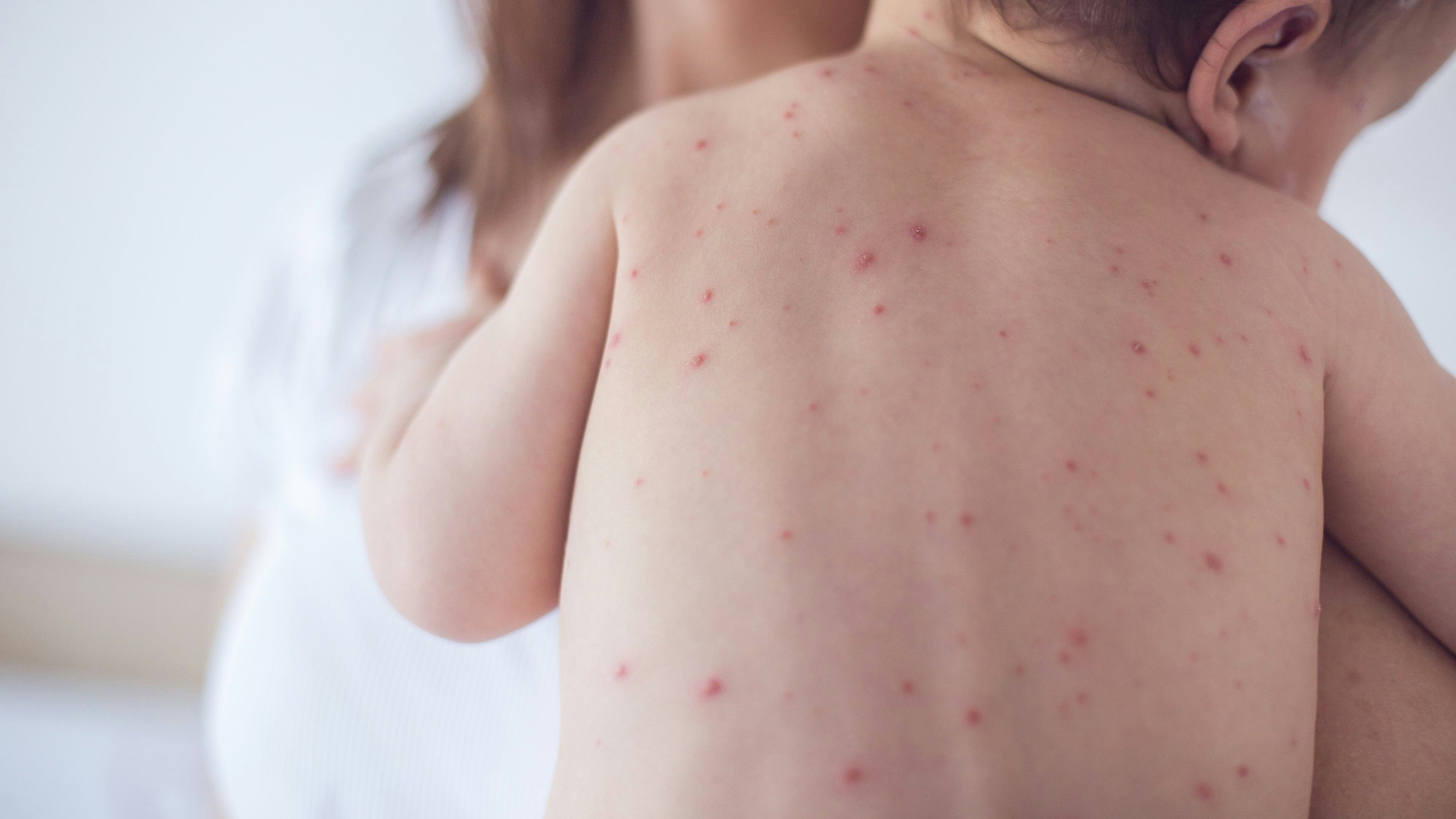 In Österreich wurden mehrere Masern-Fälle bekannt.