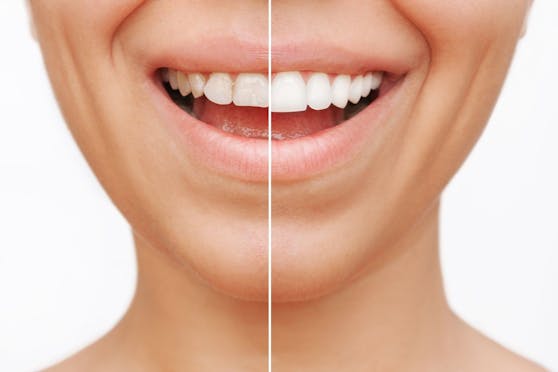 Veneers sind kleine Porzellanschalen, die dauerhaft an den Zähnen befestigt werden und die Zahnoptik stark verbessern.