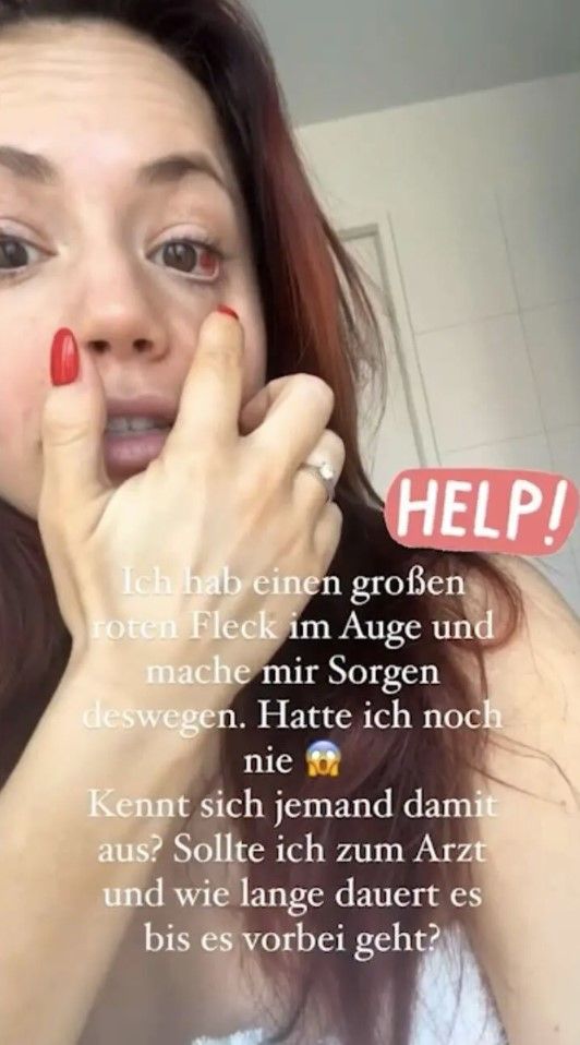 "Let's Dance"-Star Christina Luft hat einen Bluterguss im Auge.