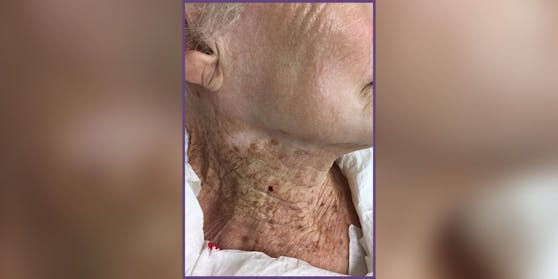 Wange und Hals einer 92-jährigen Frau, die über 40 Jahre lang UV-schützende Feuchtigkeitscremes für das Gesicht, aber nicht für den Hals verwendet hat. Der Unterschied in der Hautschädigung ist klar erkennbar.
