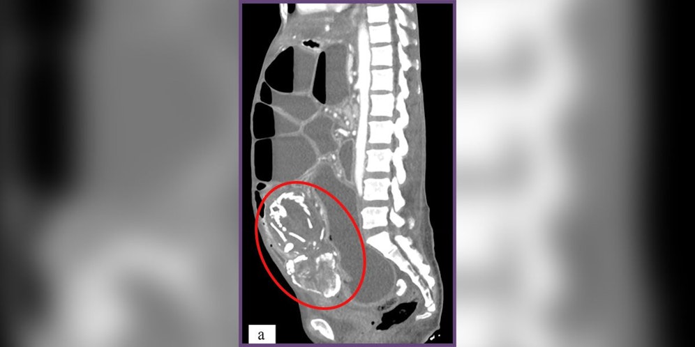 Der Scan (Bild) zeigt den knöchernen Fötus in der Bauchhöhle der Frau. 