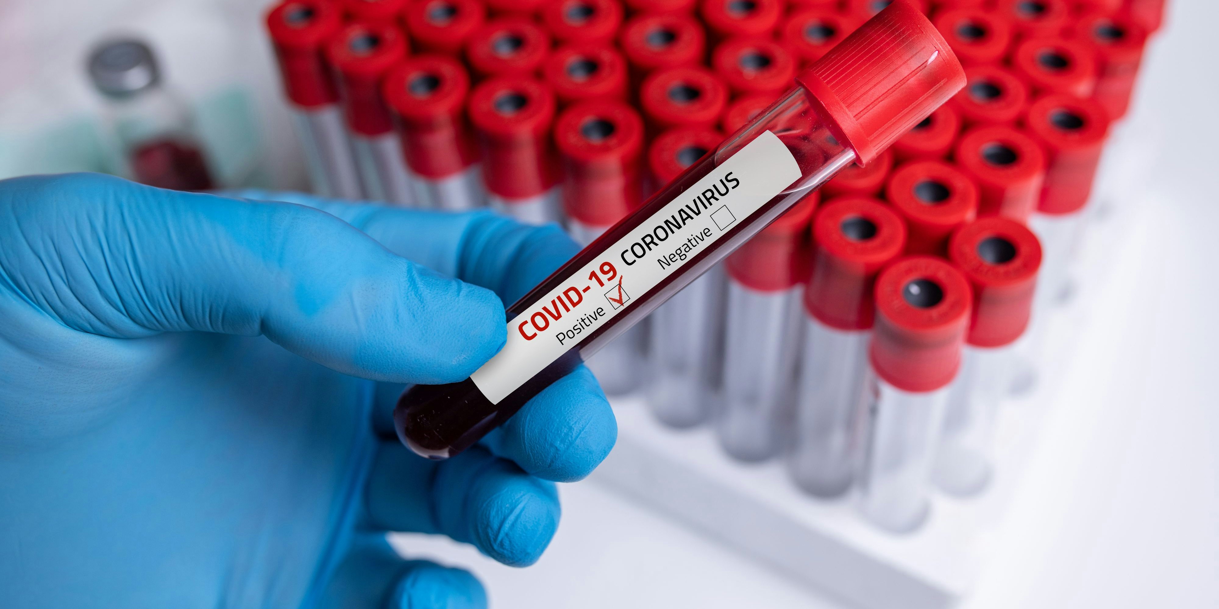 Coronavirus 2019-nCoV Blood Sample. Corona virus outbreaking. Epidemic virus Respiratory Syndrome.
