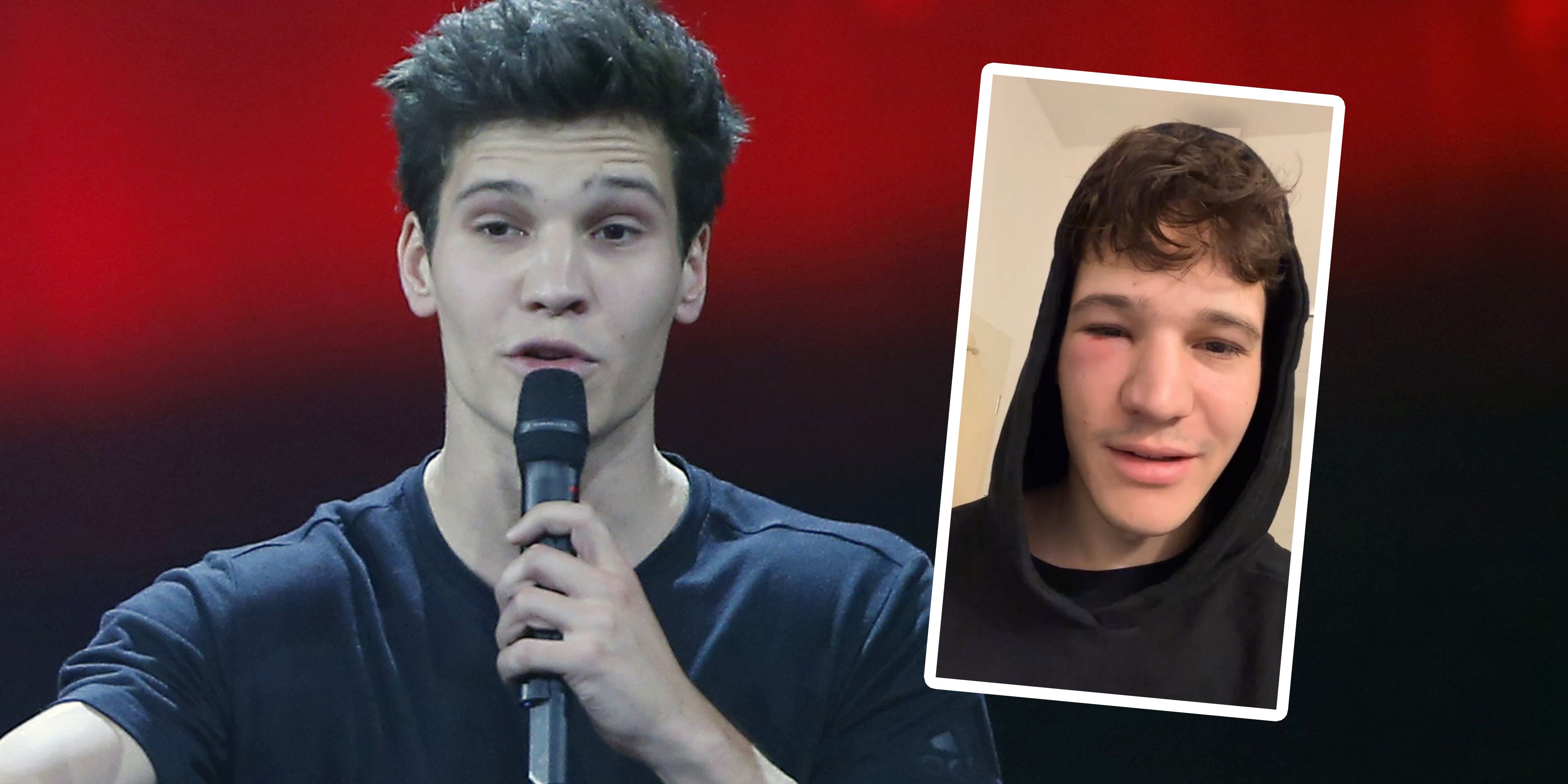 Wincent Weiss zeigt sein zugeschwollenes Auge.