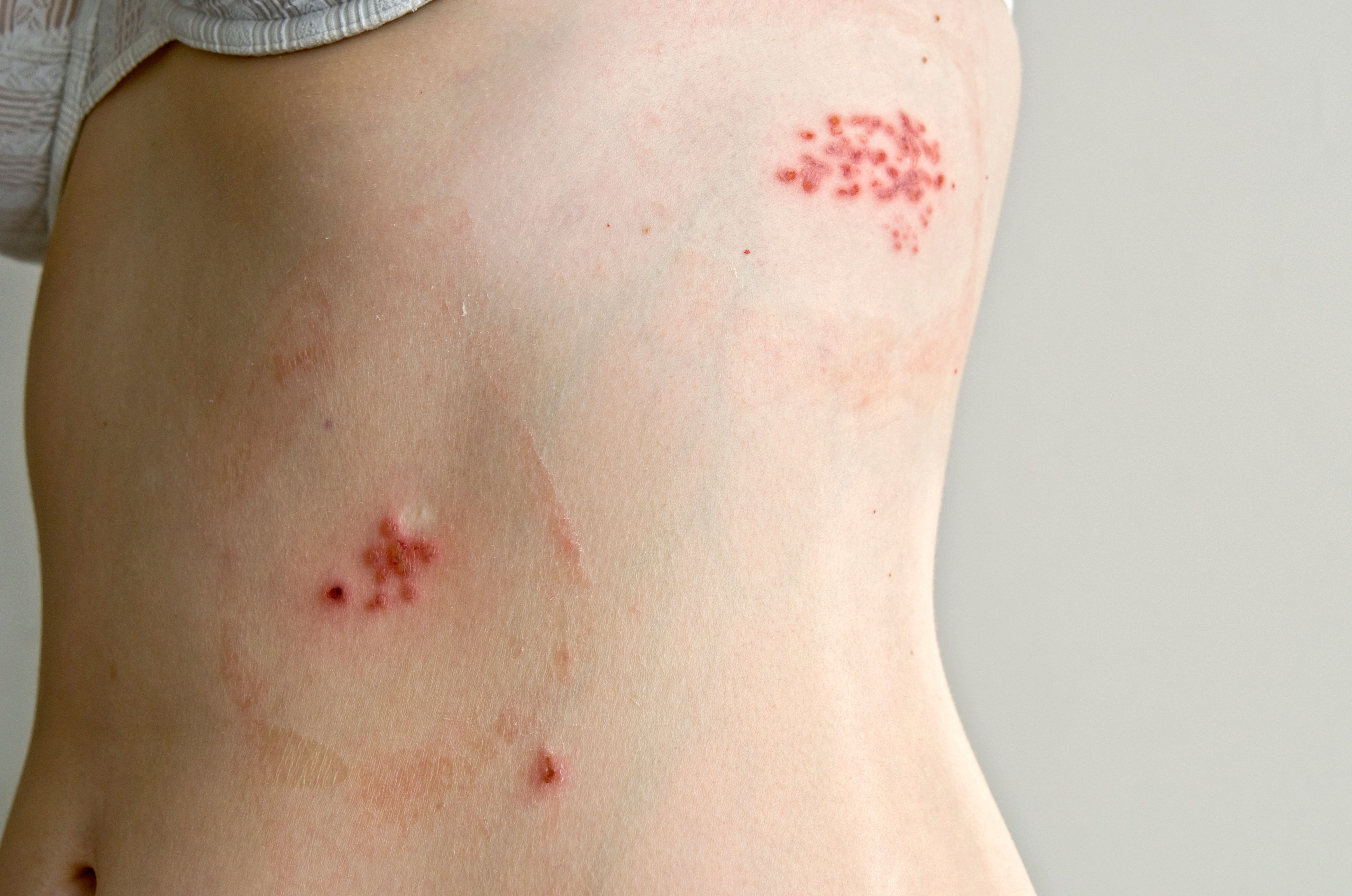 Download von www.picturedesk.com am 24.03.2023 (11:21).  MODEL RELEASED. Shingles, or herpes zoster, rash on the skin of a 31 year old woman. Shingles is a disease caused by the varicella-zoster virus (VZV), which also causes chickenpox. The virus infects sensory nerves, causing the outbreak of small blisters on the skin supplied by the nerves. These are highly infectious as they are filled with fluid containing virus particles. They last around two weeks, after which the area is intensely painful due to nerve damage. Early treatment with antiviral drugs can prevent the pain, but the virus can lie dormant in nerves for years, and nearly always recurs. Photographed one week after diagnosis; the blisters are starting to heal. - 20110419_PD4987 - Rechteinfo: Rights Managed (RM) Model Released