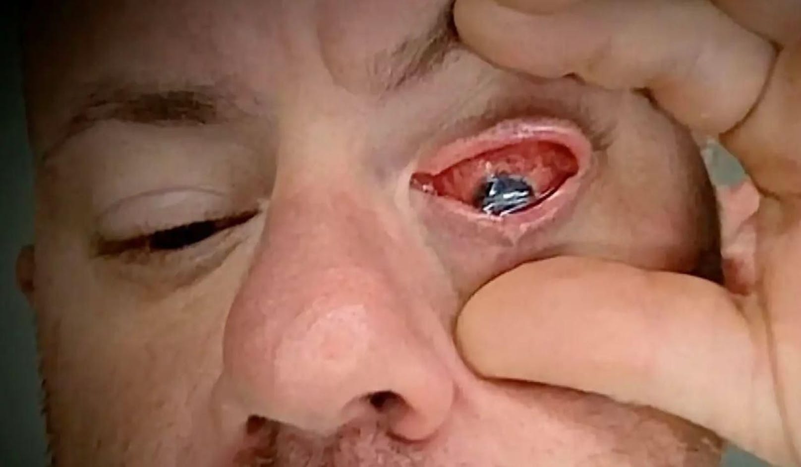 Das Auge von Adam Di Sarro, einem Feuerwehrmann aus Florida, war nach der Verwendung von Augentropfen schwer entzündet. 