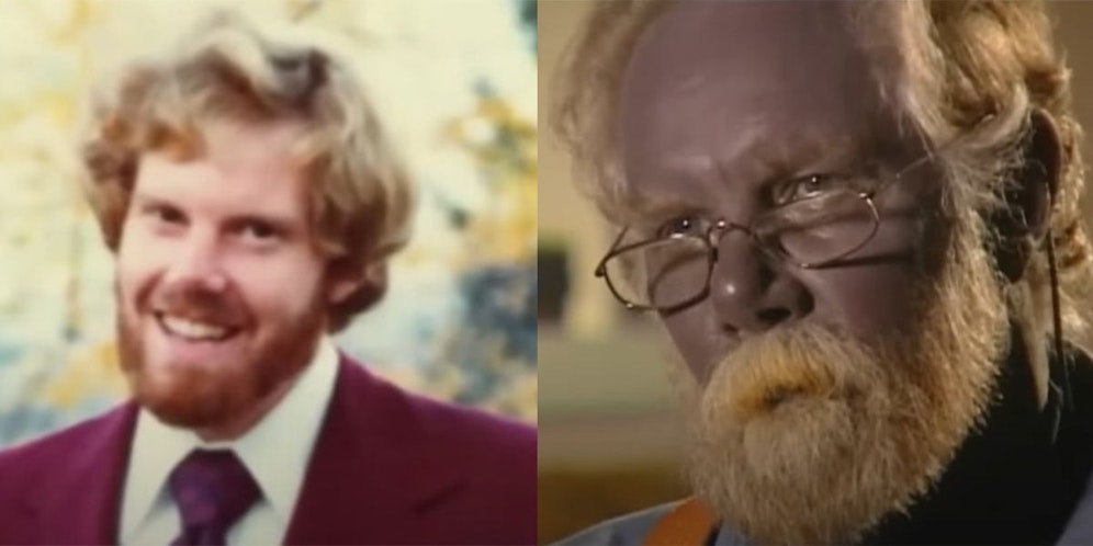 Paul Karason wurde mit heller Haut und roten Haaren geboren (li.). Jahre später war er nicht mehr wiederzuerkennen (re.). 