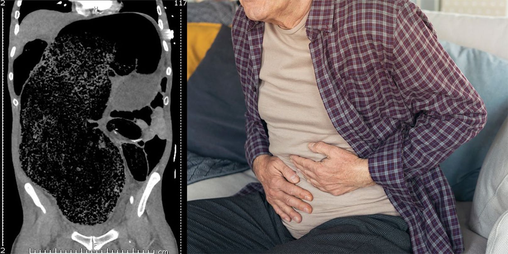 Die Ultraschallaufnahme des Mannes (li.) zeigt den massiv aufgeblähten Dickdarm. Symbolbild (re.)