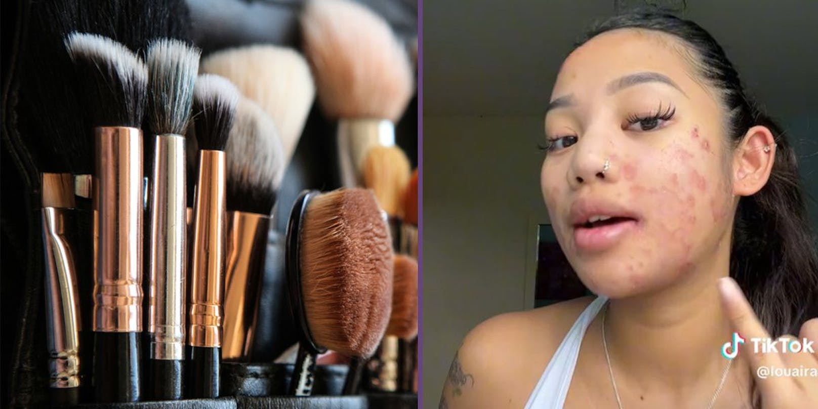Frau reinigt Make-up-Pinsel nicht – hat Pilz im Gesicht