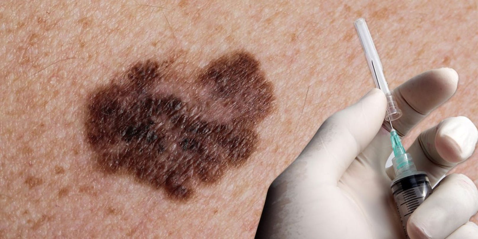 Das Melanom ("Schwarzer Hautkrebs") ist die gefährlichste Hautkrebsart. (Symbolbild).